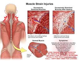 Amicus Injury Muscle Strain Injuries Back Trapezius Micro Tear Swelling Adhesion Impinge Entrap Scar Tissue Muscle Strain Muscle Adhesions Deep Tissue Massage