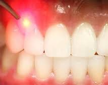 Natural Remedy For Gum Disease Dental Laser Laser Dentistry Gum Disease Treatment