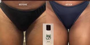 The problem is, sometimes waxing can cause skin concerns like ingrown hairs and irritation. Ingrown Hair Bikini Area Oil