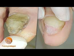 Image result for Onychogryphosis feet