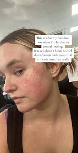 Face Psoriasis Night Routine