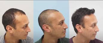 The Inspiring Hair Transplant Journey of Chris Bisson