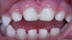 Thema Karies Magic Dental