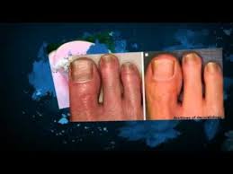 use vicks vaporrub for nail fungus