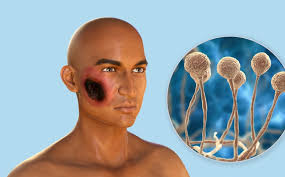 Informe sobre mucormicosis hongo negro en india. Hongo Negro En Mexico Que Es Sintomas Como Se Contagia