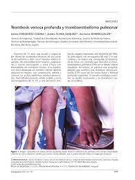 Maybe you would like to learn more about one of these? Pdf Trombosis Venosa Profunda Y Tromboembolismo Pulmonar
