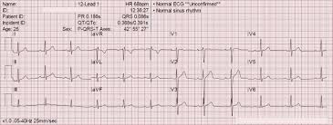 the six step method for 12 lead ecg interpretation ems 12 lead