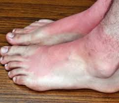 Osteoblastoma is a rare tumor that grows in your spine and long bones, mostly in young adults. What Does Foot Cancer Look Like Roseville Ankle Surgeon