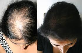 يعتقد البعض أن دور عملية زراعة الشعر يقتصر على علاج حالات الصلع التام، إلا أن التجربة أثبتت أنها أحد حلول مشكلات الشعر الخفيف أو ترقق الشعر نظراً لما تحققه من نتائج فعالة وسريعة ومضمونة بنسبة كبيرة مقارنة بالوسائل العلاجية الأخرى. Ø§Ù„Ø¬Ø§Ø± ÙƒÙŠÙ†ÙŠØ§ Ù…Ø¹Ø¬Ù… Ø§Ù„Ø´Ø¹Ø± Ø§Ù„Ø®ÙÙŠÙ Ù…Ù† Ø§Ù„Ø§Ù…Ø§Ù… Ø¹Ù†Ø¯ Ø§Ù„Ù†Ø³Ø§Ø¡ Retchlessweather Com