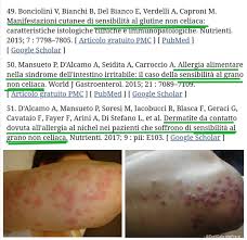 Deve essere, però, una sensazione ricorrente perché sia sintomo di intossicazione del fegato. Dr Gabriele Prinzi Dermatite Erpetiforme Come Manifestazioni Extraintestinale Da Sensibilita Al Glutine La Sensibilita Al Glutine Non Celiaca Ncgs E Una Sindrome Caratterizzata Da Una Coorte Di Sintomi Correlati All Ingestione