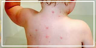 Chicken pox is a common viral infection caused by the virus of the herpes family. Terkena Jangkitan Chicken Pox Ini Makanan Yang Boleh Juga Perlu Dielakkan Diberi Kepada Anak Yang Mengalami Chicken Pox Semua Kasi Potong