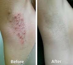 The face, neck, armpits, chest, legs, and pubic area are some of the common spots for ingrown hairs. Products For Anyone Who S Ready To Break Up With Razor Bumps