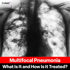 Image result for Pneumonia