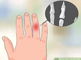 How To Treat A Jammed Finger Jammed Finger Finger Broken Finger