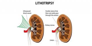 Lithotripsy Treatment For Kidney Stone Purpose Procedure Risks Rg Hospital