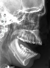 The tmj (the jaw joint) is located right in front of your ears, where the skull bone meets the mandible, or lower jaw. Management Of Recurrent Dislocation Of The Temporomandibular Joint Tmj Penn Medicine