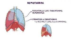 Image result for Hemothorax