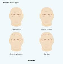 Check out these stunning hairstyles that can help disguise a receding hairline in females — and get inspired to try a new look today! Normal Hairline How It Looks Compared To Receding