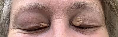 Image result for xanthelasma of eyelid