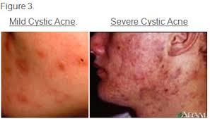Do I Have Cystic Acne Symptoms Warnings And Treatment