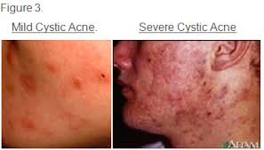 Acnes bacteria that naturally live on skin overgrow within this plugged follicle, the area becomes below are the best acne treatments for occasional, mild, and some moderate acne. Do I Have Cystic Acne Symptoms Warnings And Treatment