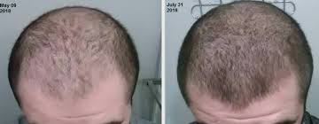 Suave® makes it easy to look & feel great everyday!. Would Scalp Micropigmentation Help Make My Hair Look Fuller Photo Wrassman M D Baldingblog