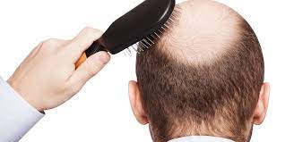 Con l'arrivo dell'autunno è comune osservare una maggior caduta dei capelli; Perdita Dei Capelli Come Curarla Marina Benedetti