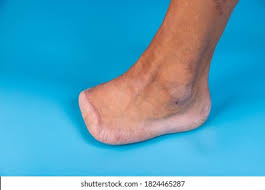 Image result for toe amputation