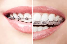 We did not find results for: Crooked Teeth Invisible Teeth Correction Drsmile