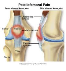 Runner S Knee Patellofemoral Pain Syndrome What Is It