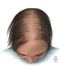 Most women notice it in their 50s or 60s, but it can happen at any age. Hair Loss In Women Causes Treatment Prevention