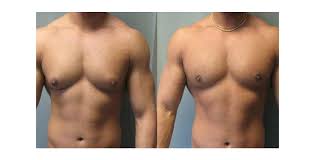 Vazer ve lazer liposection nedir. Jinekomasti Kolan Estetik Kolan Hospital Group