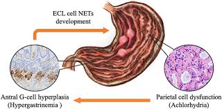 Abraham ooi & partners, +2 more. Enterochromaffin Like Cell Neuroendocrine Tumor Associated With Parietal Cell Dysfunction Gastrointestinal Endoscopy