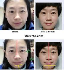 Whether you're looking to even out the size of your eyes, adjust the shape or your nose, or correct a lopsided smile, face yoga is a wonderful way to fix asymmetrical face and create a more symmetrical look 100% naturally. How To Develop Widen And Make Your Face More Symmetrical