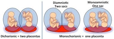 Complicated Monochorionic Twins Johns Hopkins Center For