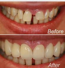 Pin On Teeth