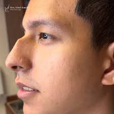 🙋🏻‍♀️ Cambios increíbles con una rinoplastia. Atrévete a conocer una  nueva versión de ti y realza tu belleza con una transformación que te hará  sentir mucho más seguro y feliz ✨, 👩🏻‍⚕️ Dra. Ethel ...