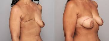 Breast reconstruction is an integral part of breast cancer treatment. Reconstruction Mammaire Turquie Devis Gratuit D Un Sejour Medical