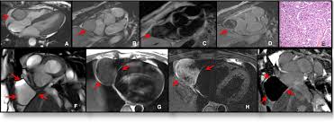 50% of which are from malignant melanoma; Assessment Of Cardiac Masses By Cardiac Magnetic Resonance Imaging Histological Correlation And Clinical Outcomes Journal Of The American Heart Association