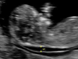 increased fetal nuchal translucency thickness and normal