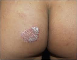 Tuberculosis cutis — localización de la tuberculosis en la piel; Cutaneous Tuberculosis A Great Imitator Clinics In Dermatology