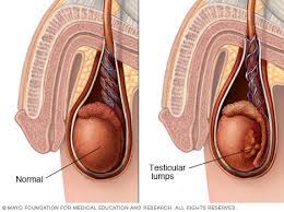 By stage iii, the cancer is considered advanced and may have spread to other areas of the body, such as the lungs. Testicular Cancer Symptoms And Causes Mayo Clinic