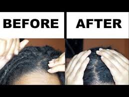 How To Get Rid Of Dry Itchy Scalp In 15 Mins Without Washing Your Locs Youtube Dry Itchy Scalp Dry Skin Care Itchy Dry