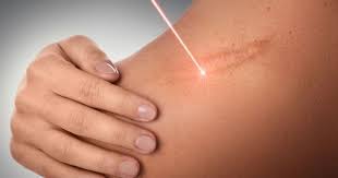 Cara ampuh hilangkan stretch mark. 6 Cara Menghilangkan Stretch Mark Di Payudara Popmama Com