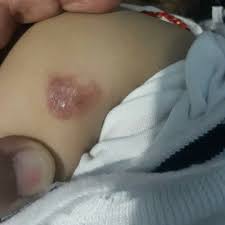 In further tests, the use of sls at induction and at challenge increased the incidence of skin reactions. After Applying Soframycin Cream On Hair Wound No Hair Growth In That Area Firstcry Parenting