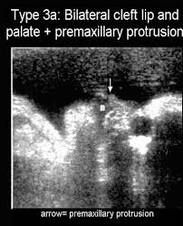 Ultrasound Of Cleft Lip And Palate Cleft Lip Cleft Lip And Palate Ultrasound