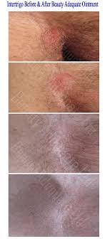 Intertrigo is a superficial inflammatory dermatitis occurring on two closely opposed skin surfaces as a result of moisture, friction, and lack of ventilation. Intertrigo Intertriginous Dermatitis Ointment Beauty Adequate