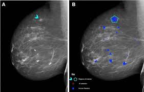 Image result for Mammogram