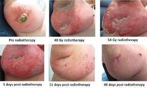 The growth resembles a squamous cell skin cancer, but it grows more rapidly than a squamous cell cancer.keratoacanthomas grow rapidly, enlarging by up to 1 to 3 centimeters within a few weeks. Cureus Merkel Cell Carcinoma When Does Size Matter For Radiotherapy