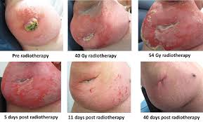 @article{beck1989merkelct, title={merkel cell tumor.}, author={l. Cureus Merkel Cell Carcinoma When Does Size Matter For Radiotherapy